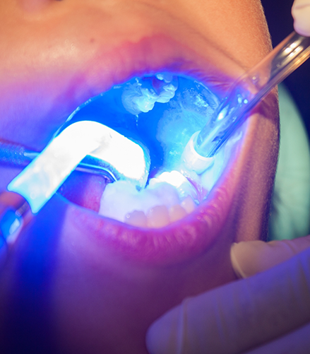 Close up of dental sealants being applied to the teeth