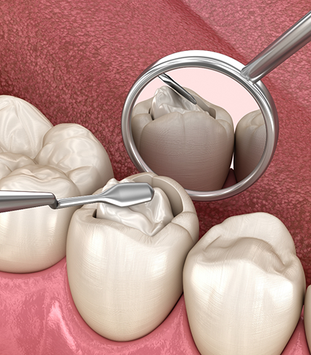 Illustration of dental instruments treating the innermost layer of a tooth