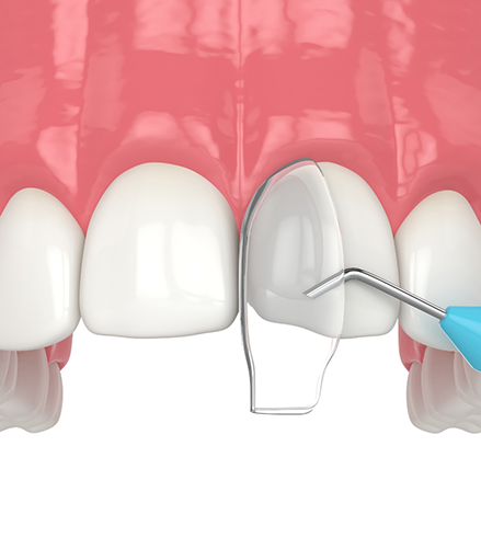 Illustration of bonding material being applied to a chipped tooth