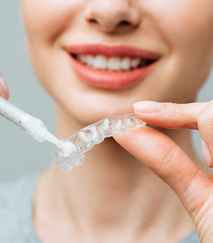 Person placing bleaching gel into a teeth whitening tray