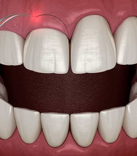 Illustration of a dental laser treating an uneven gumline