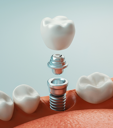 Illustrated dental implant with crown being placed in the lower jaw