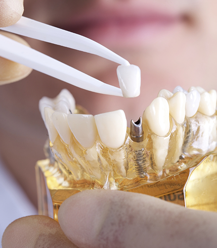 Dentist placing a dental crown on a model of a dental implant