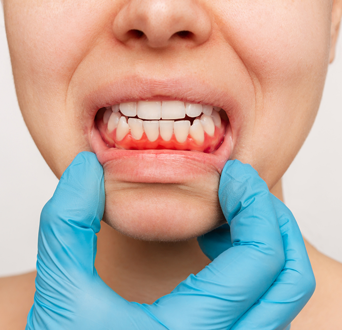 Person pointing to their red gums before gum disease treatment in Independence