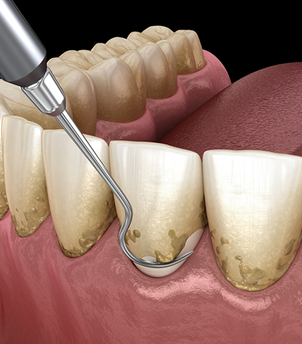 Illustration of a dental scaler clearing plaque buildup from the gumline