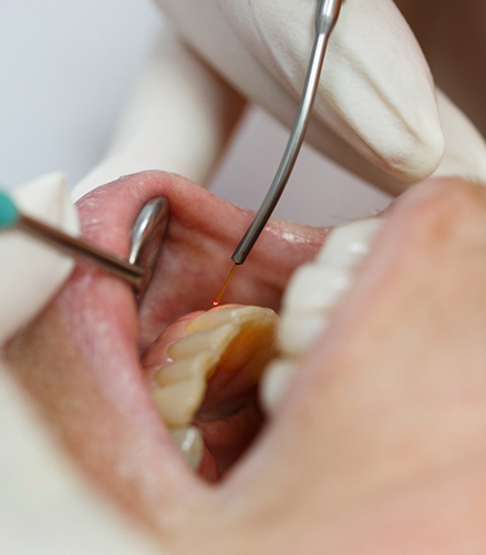 Dental patient having their gums treated with a soft tissue laser