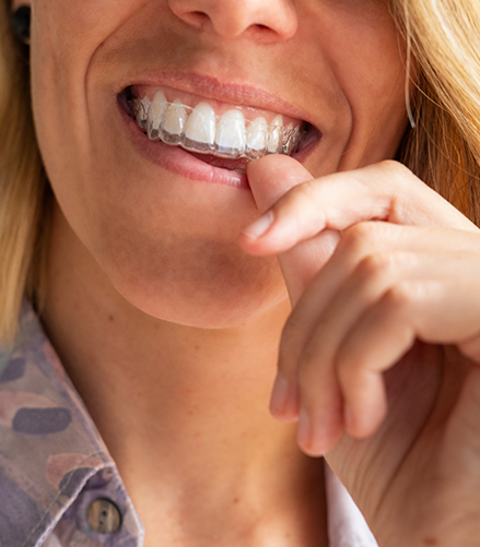 Blonde woman placing an Invisalign tray over her teeth