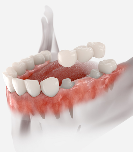 Model of a dental bridge replacing a missing lower tooth