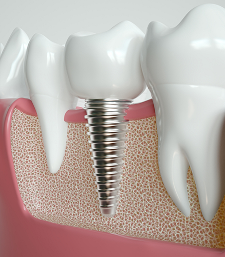 Illustration of a dental implant in the lower jawbone