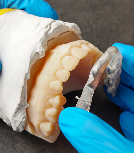 Dentist placing an occlusal splint over a model of an arch of teeth