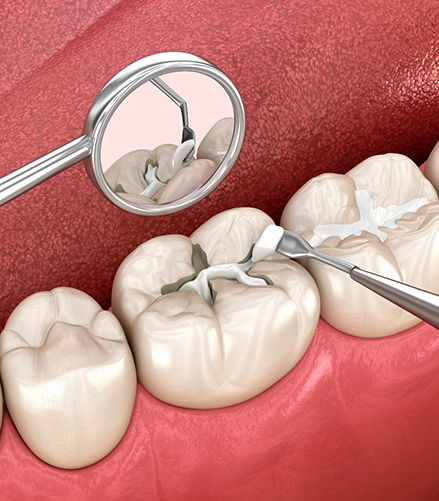 Illustration of a white filling being placed in a tooth