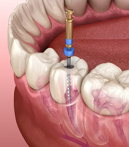 Illustration of a dental instrument treating the inside of a tooth