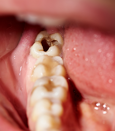 Close up of a mouth with a severely damaged and decayed tooth